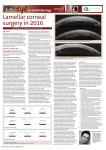 Lamellar corneal surgery in 2016