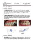 Class II malocclusion