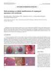 Skin metastases as initial manifestation of esophageal squamous