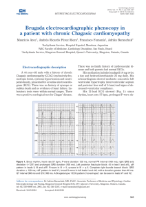 Brugada electrocardiographic phenocopy in a patient with chronic