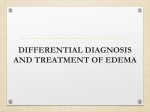 distribution of edema