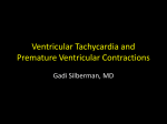 Ventricular Tachycardia and Premature Ventricular Contractions