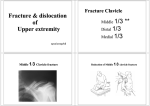 Fracture Clavicle