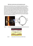 DMEK latest in selective tissue corneal transplantation surgery