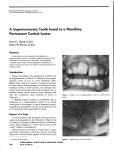 A Supernumerary Tooth Fused to a Maxillary Permanent Central