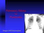 Pulmonary Edema vs Pneumonia