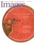 Cancers of the Eye - Bascom Palmer Eye Institute