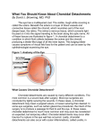 Choroidal Detachment - The Retina Reference