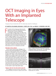 OCT Imaging in Eyes With an Implanted Telescope