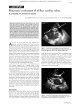 Rheumatic involvement of all four cardiac valves - Heart