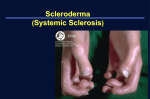 Systemic Sclerosis (Scleroderma)