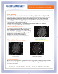 BRAIN METASTASES: BREAST CANCER Patient Spotlight