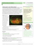 Intraocular Lens Dislocation Cataract surgery