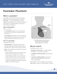 Pacemaker Placement - Intermountain Healthcare