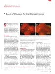 A Case of Unusual Retinal Hemorrhages Stanley