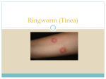 Ringworm (Tinea)