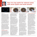 New iris ring useful for cataract cases with small pupils and weak