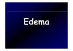 Edema