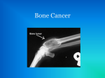 Bone Cancer - Knee Differential Diagnosis