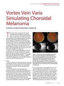 Vortex Vein Varix Simulating choroidal Melanoma