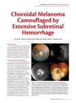 Choroidal Melanoma Camouflaged by Extensive Subretinal