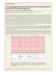 Occasional dropped ventricular pacing in apatient with no