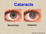 What causes a Cataract?