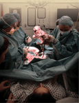 Emergency Cesarean Delivery in the Labor