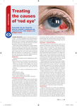 Treating the causes of `red eye`