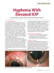 Hyphema With Elevated IOP