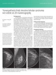 Tomosynthesis finds invasive lobular carcinoma not visible