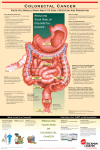 to view a colon cancer information fact sheet.