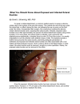 Exposed, Infected Scleral Buckle