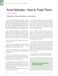Acne Nodules - How to Treat Them.