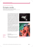 Ectopia cordis - Cardiovascular Medicine