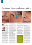 Radiowave Surgery to Remove Moles