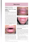 Perioral eczema and perioral dermatitis