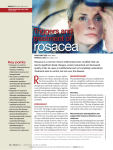 Triggers and treatment of rosacea