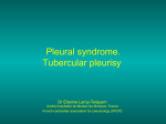 Pleural syndrome. Tubercular pleurisy
