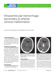 Intraventricular hemorrhage secondary to arterial venous malformation