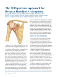The Deltopectoral Approach for Reverse Shoulder