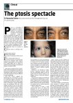 The ptosis spectacle