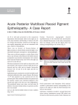 Acute Posterior Multifocal Placoid Pigment Epitheliopathy- A