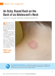 An Itchy, Round Rash on the Back of an Adolescent`s Neck