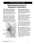 Needle Aponeurotomy for Dupuytren`s Contracture