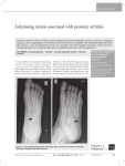 Ankylosing tarsitis associated with psoriatic arthritis