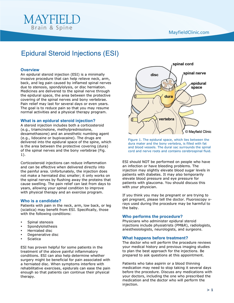 Epidural Steroid Injections (ESI) Epidural Steroid Injections (ESI)