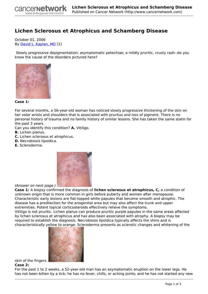 Lichen Sclerosus Et Atrophicus And Schamberg