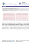 EKG Changes in Severe Hyperkalemia in Digoxin Toxicity