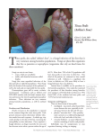 T Tinea Pedis (Athlete’s Foot)